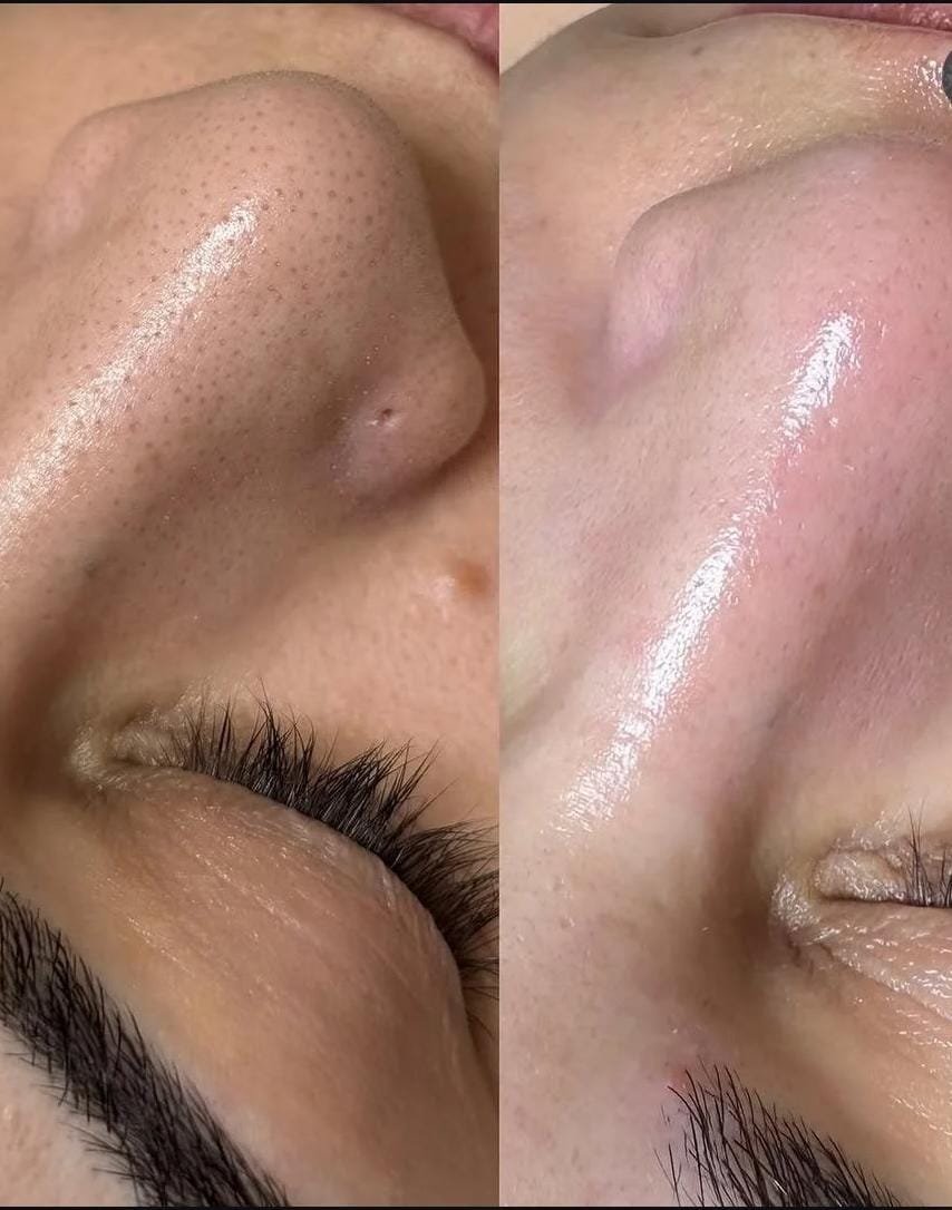 Before and after Crystal Clear facial treatment